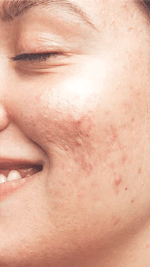 acne do's and dont's